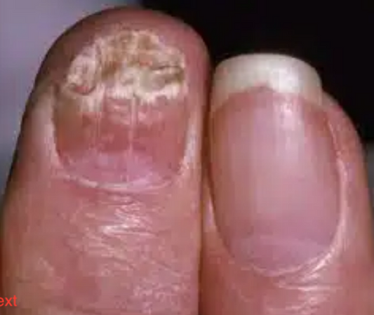 Fighting fungal infection of toenails, fingernails, skin and hair naturaly.