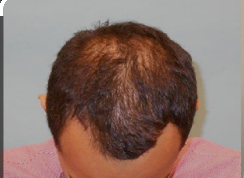 Reverse hair loss with natural remedies.